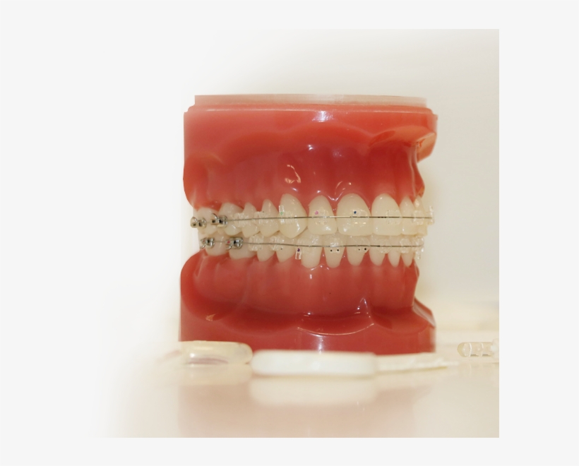 Clear Braces - Plastic, transparent png #878492