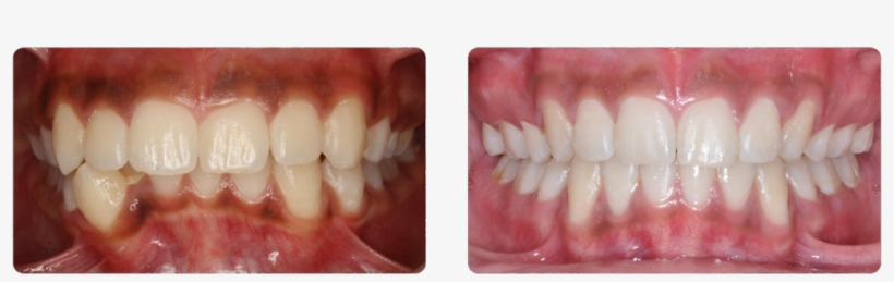 Deep Bite And Severe Lower Crowding That Were Corrected - Vampire, transparent png #8736721