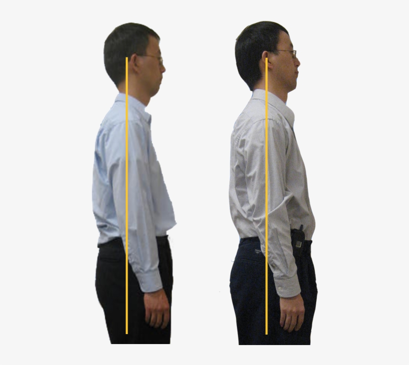 Breathing Difficulties - Forward Neck Posture Before And After, transparent png #8740278