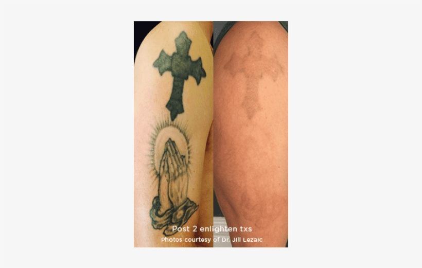 Tattoo Removal* - Tattoo, transparent png #8743878