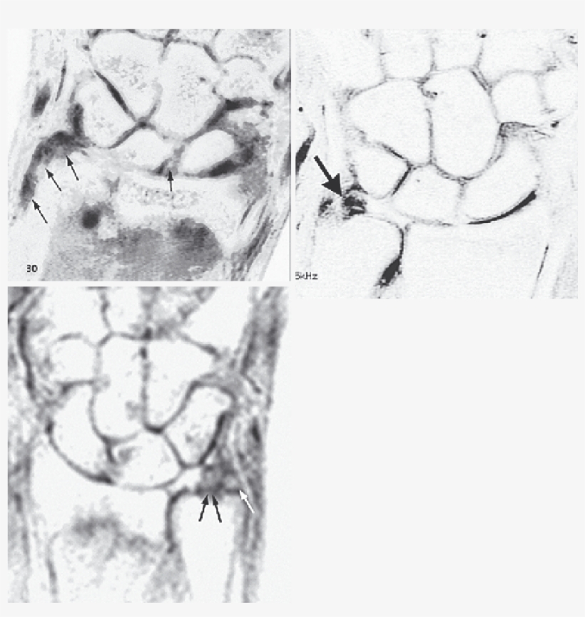Triangular Fibrocartilage Tear Syndrome - Medical Imaging, transparent png #8753391