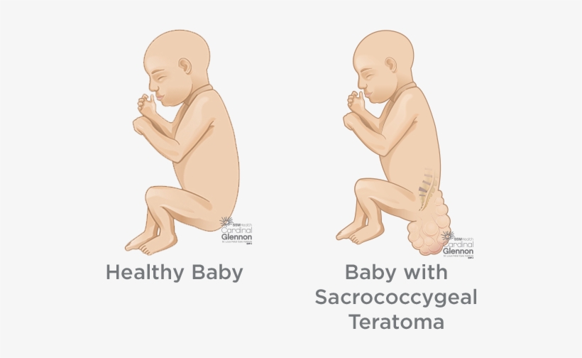 How Is Sct Diagnosed During Pregnancy - Children’s Healthcare Of Atlanta, transparent png #8764945
