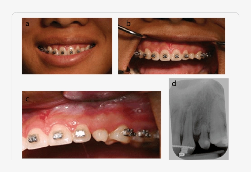 Situation After Completion Of Orthodontic Treatment - Collage, transparent png #8816258