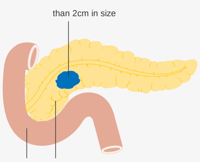 P Pancreatic Cancer - Diagram, transparent png #8916209