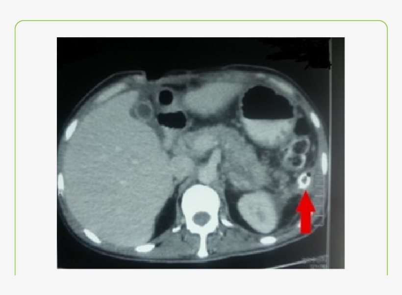 Post Operative Pancreatic Contrast Enhanced Ct Abdomen - Radiology, transparent png #8916404