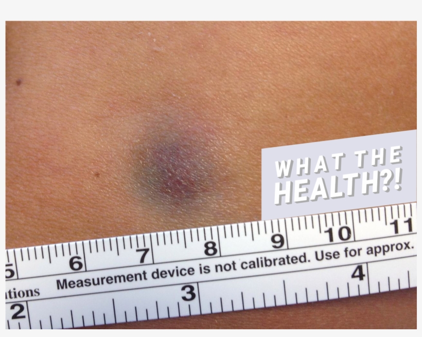 Bruise Skin Woman Health Condition Disease - Scar, transparent png #8943948