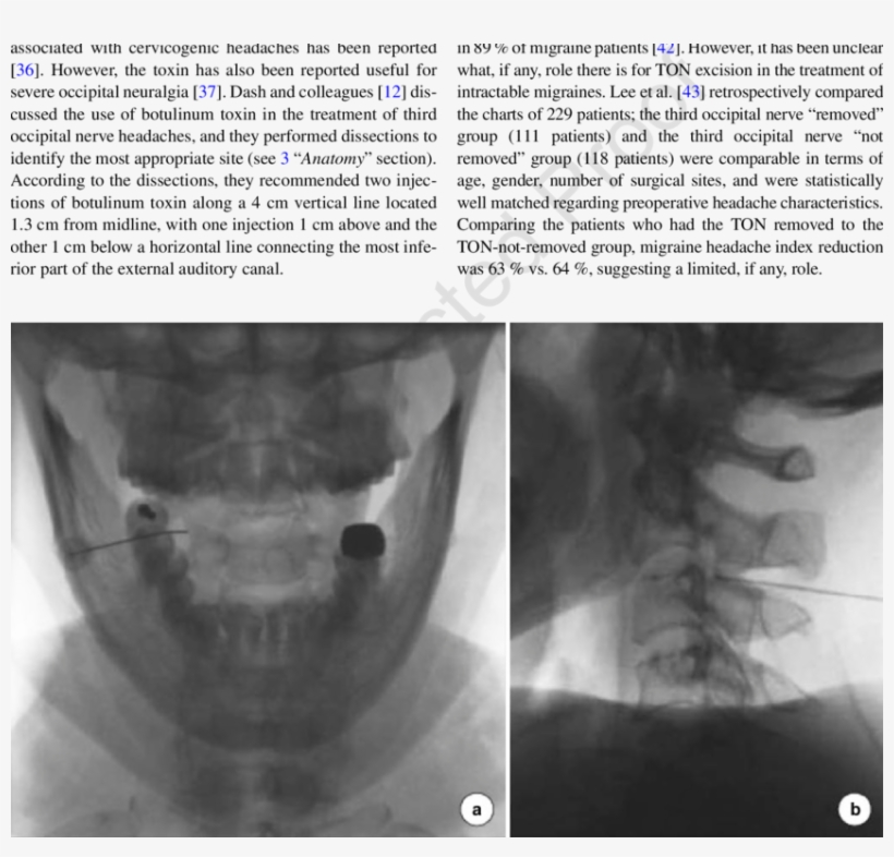 21 Open-mouth Radiofrequency Lesioning - Radiology, transparent png #8969328