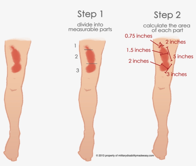 Scar Example 3 - Military Scars, transparent png #98121