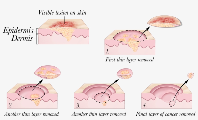 2010 Terese Winslow - Mohs Surgery, transparent png #9009415