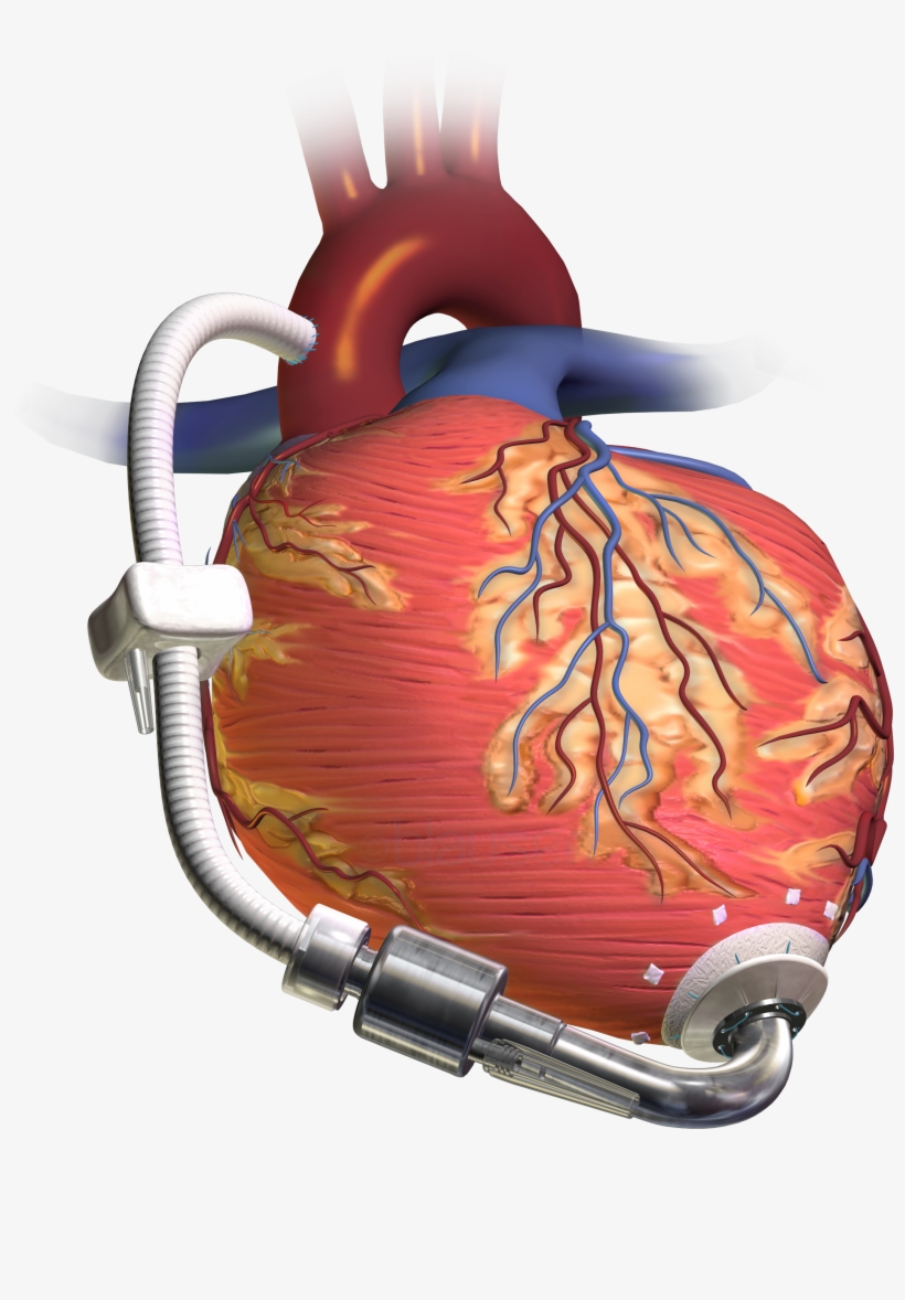 Henrico To Provide Ems Training For Patients With Heart - Heart Lvad, transparent png #9010562