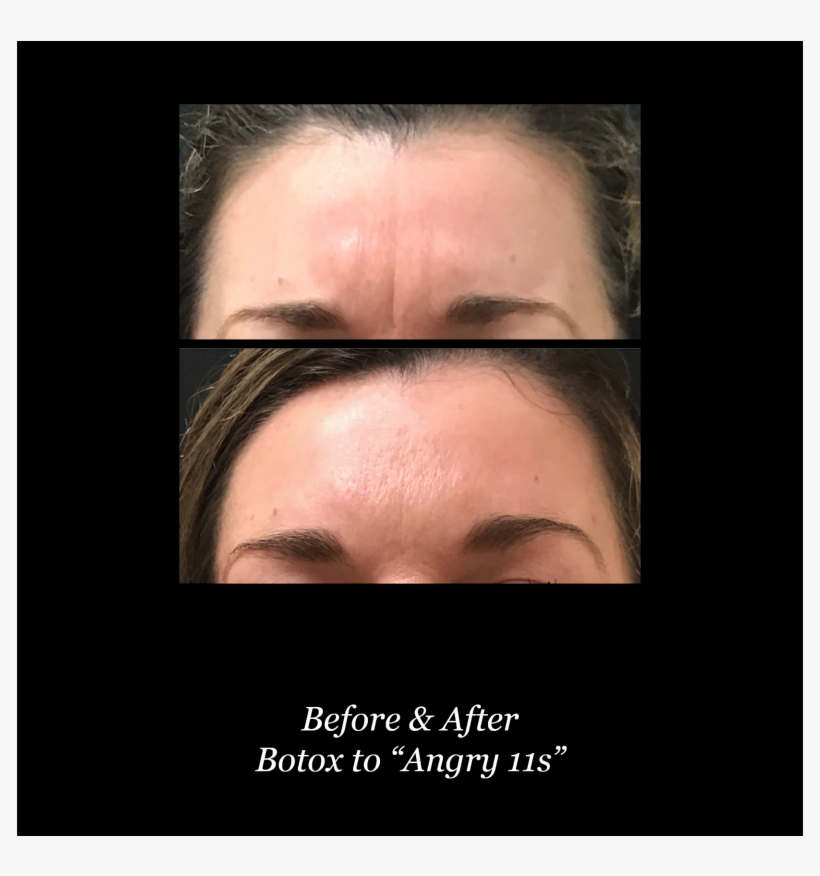 Both Botox® And Dysport Are Reversible If The Patient - Poster, transparent png #9077839