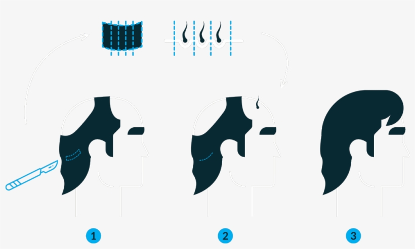 Follicular Unit Grafting, transparent png #9137513