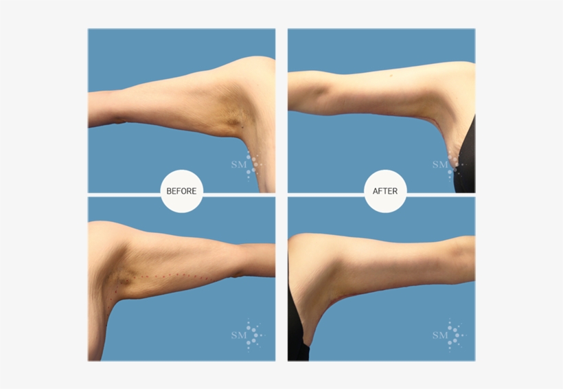 Brachioplasty - Jumping, transparent png #9154240