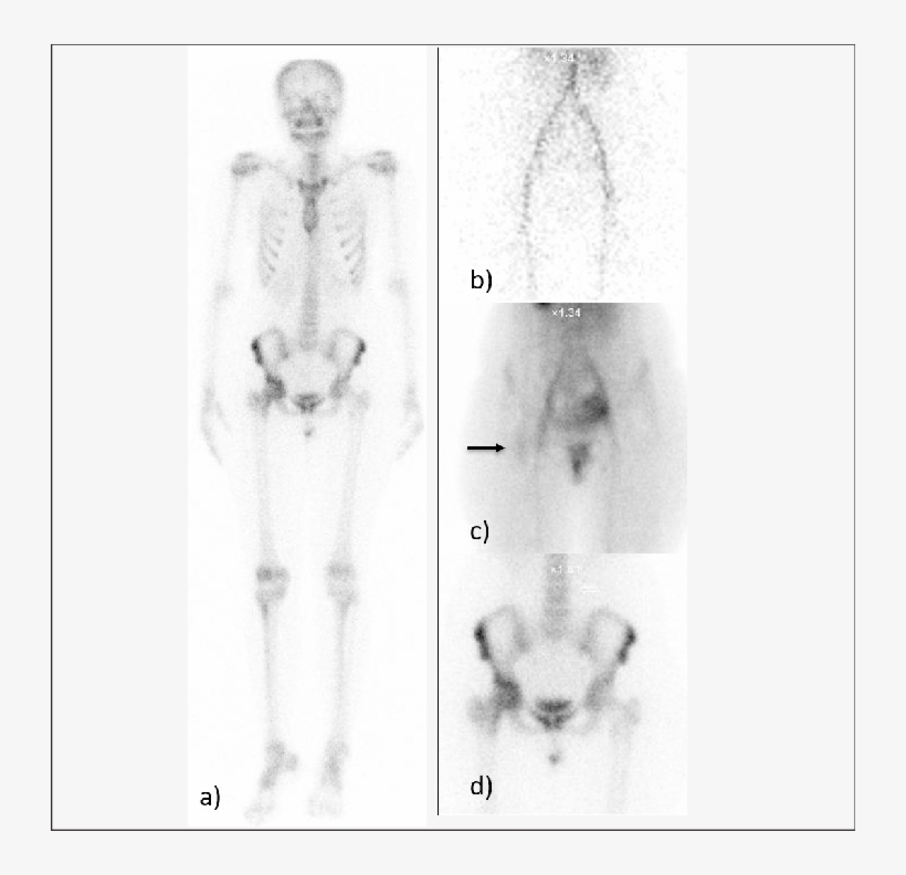 A)-(d) Bone Scan Showing Increased Blood Pool (arrow) - Uptake, transparent png #922955
