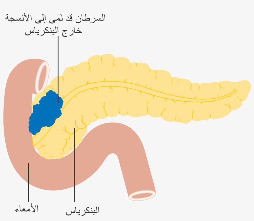 Open - Cancer De Pancreas Png, transparent png #9201095
