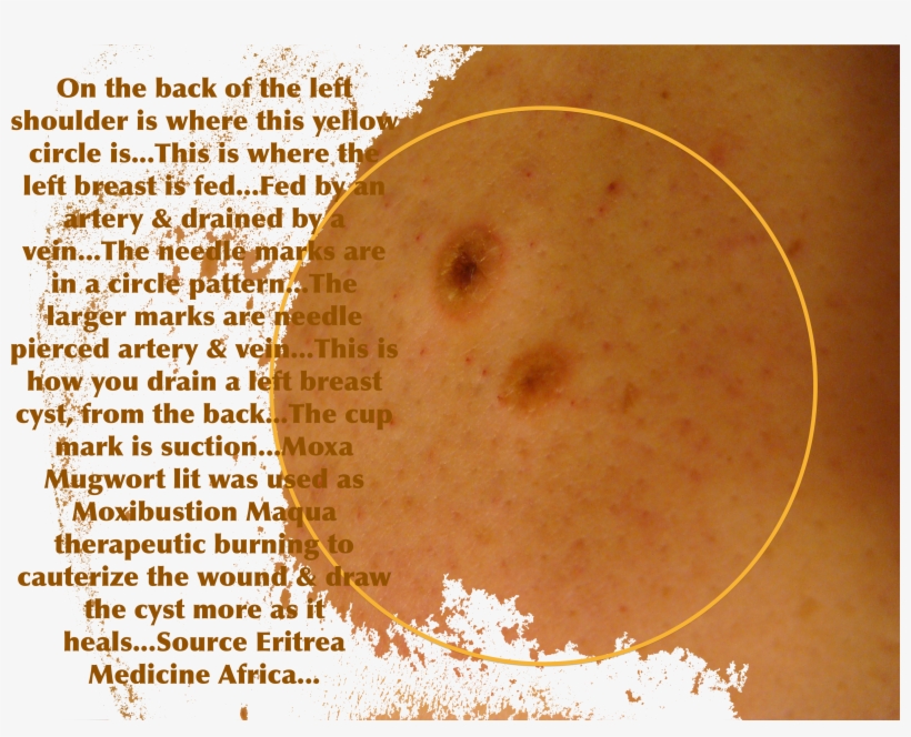 Cupping - Fire Cupping Cyst, transparent png #9223544