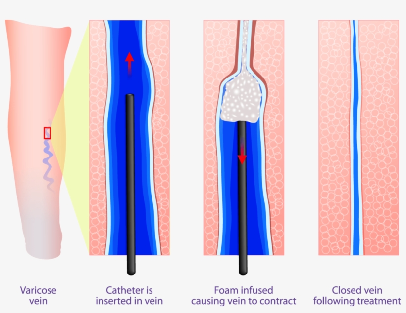 Sclerotherapy-treatment, transparent png #9255061