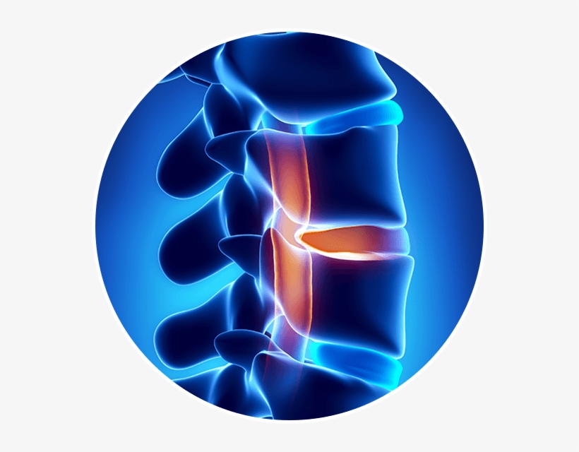 Spinal Stenosis Scar Tissue Or Surgical Error From - Bel Fıtığı, transparent png #9303207