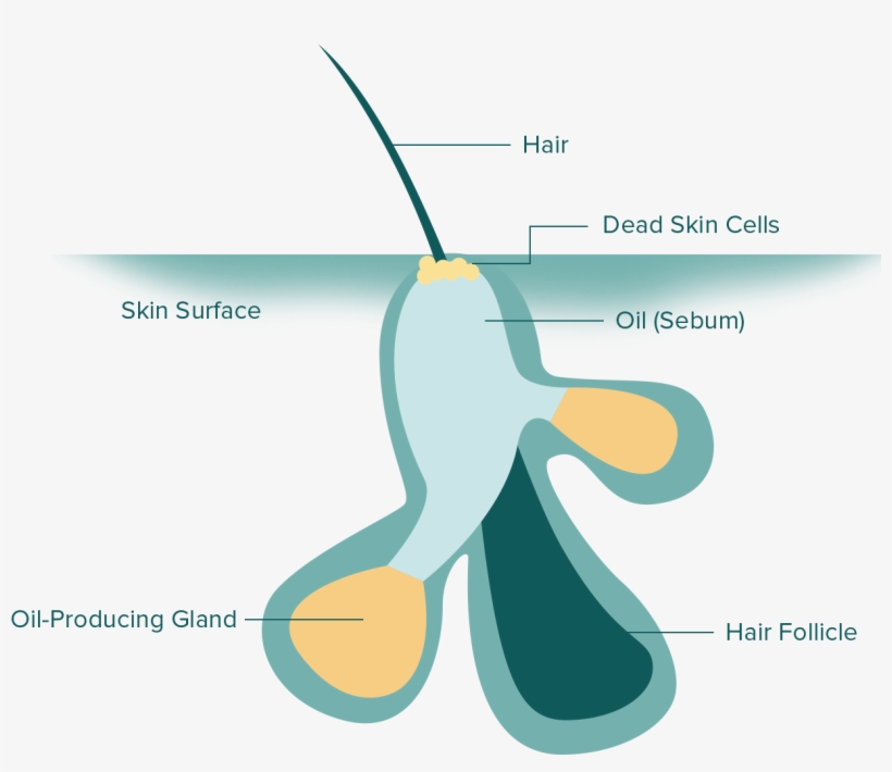 What Is Acne - Graphic Design, transparent png #9313640