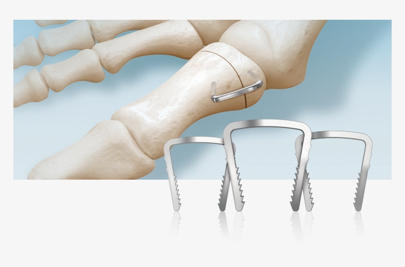 Neospan Se Compression Staple - Basic Pump, transparent png #9420005