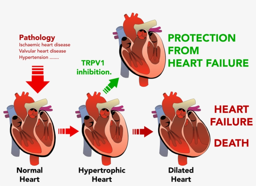 Png Transparent Stock Disease Clipart Heart Damage - Hypertrophy Heart Failure, transparent png #9421768