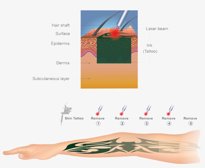 Colaz Tattoo Removed - Tattoo, transparent png #9436337