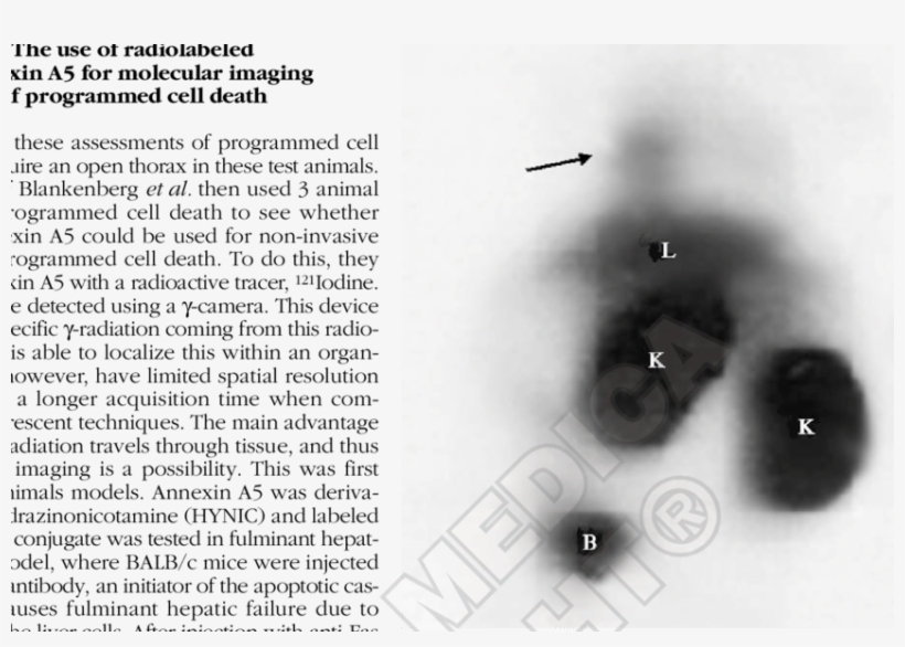 Arrowhead Points Out Uptake Of Technetium Labeled Annexin - Number, transparent png #9469707