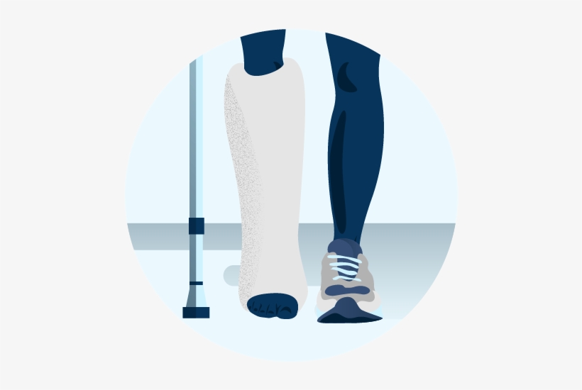 Illustration Of A Person's Leg In A Cast - Illustration, transparent png #9472984