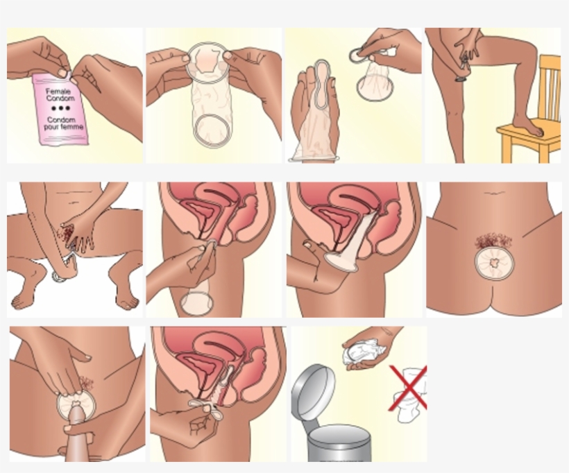 Before Using The Female Condom For The First Time During - Use Condom, transparent png #9477191