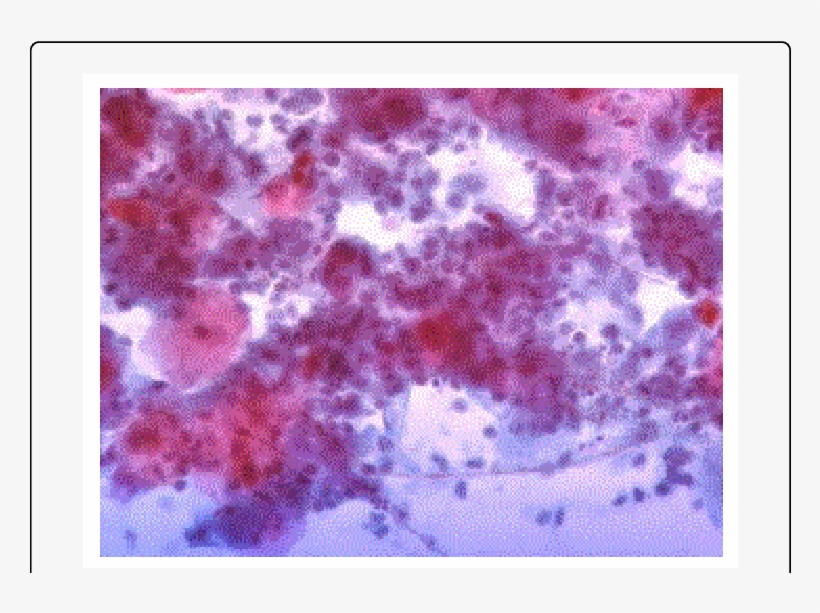 Yeast And Hyphae In Distal Esophagus Brush - Esophagus, transparent png #958600
