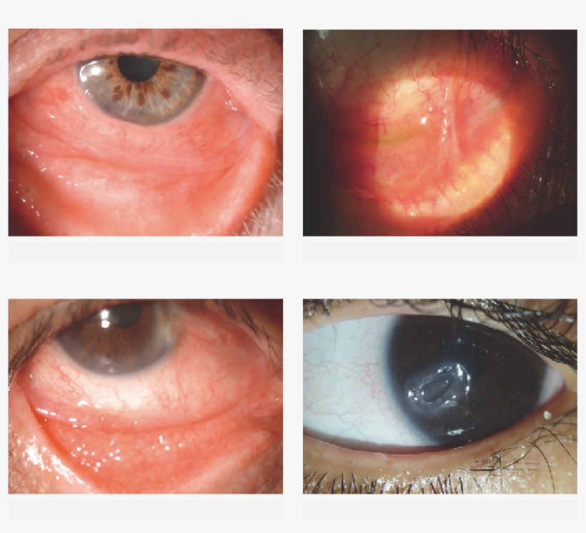 Ocular Surface Disease - Close-up, transparent png #9538152