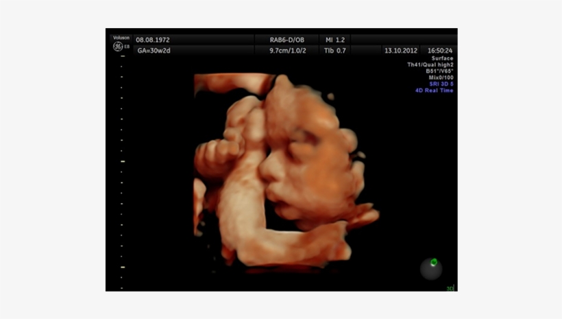 Immobile Fetus At 31 Weeks - Ultrasound 4d 31 Week, transparent png #9542627