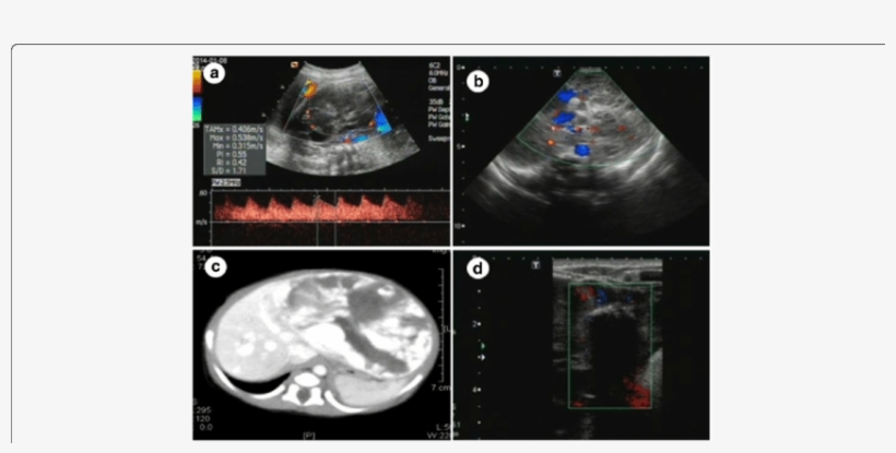 Fetus With Multiple Hemangiomas In The Whole Liver - Computed Tomography, transparent png #9542777