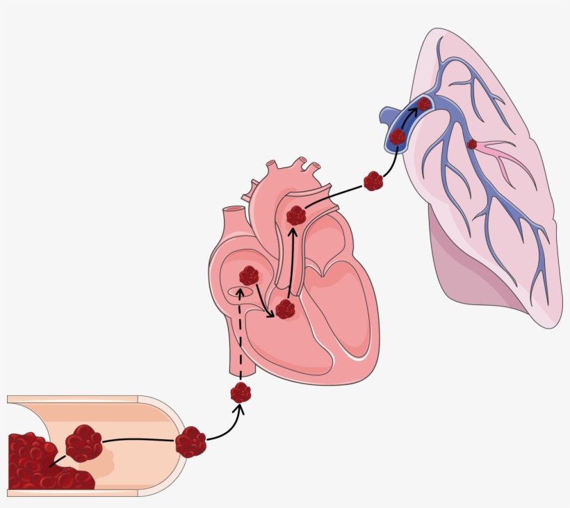 1351 X 1140 5 - Pulmonary Embolism Clipart, transparent png #9565236