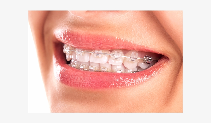 Brackets-esteticos - White Braces, transparent png #9566750
