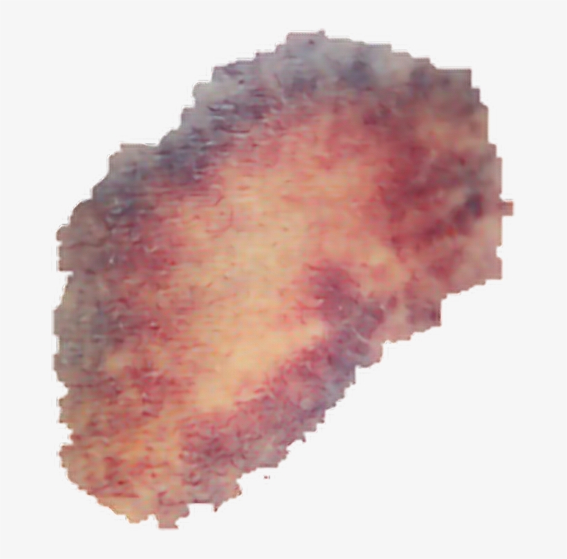 Collection Of Free Bruising - Transparent Bruise Png, transparent png #966186