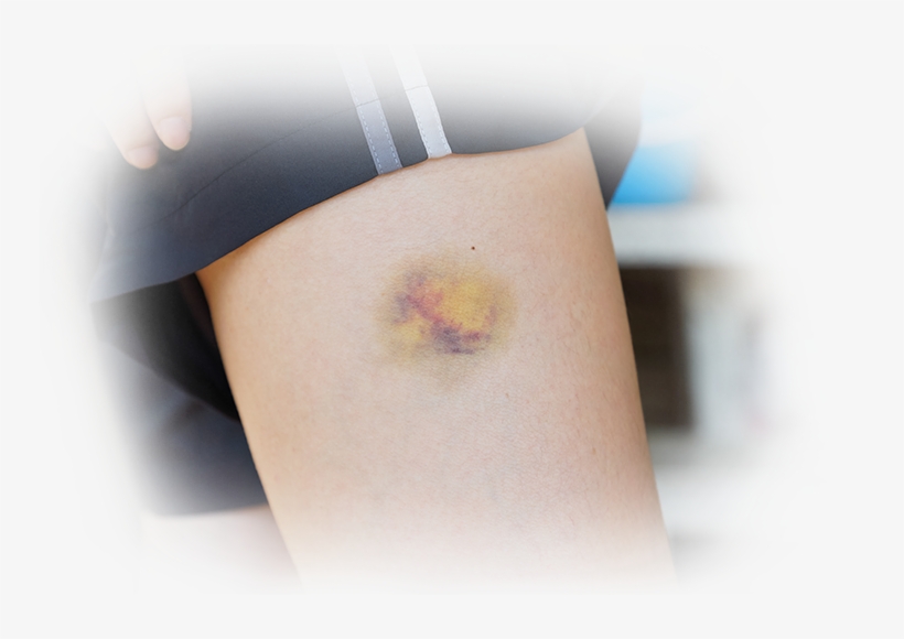 Sudden Unexplained Bruises - Cross, transparent png #966237