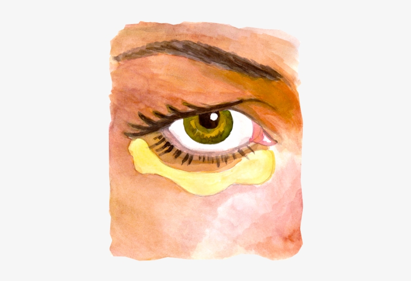 Diagram Of Fatty Bags And Incisions - Sv Plastinės Chirurgijos Centras, transparent png #966349