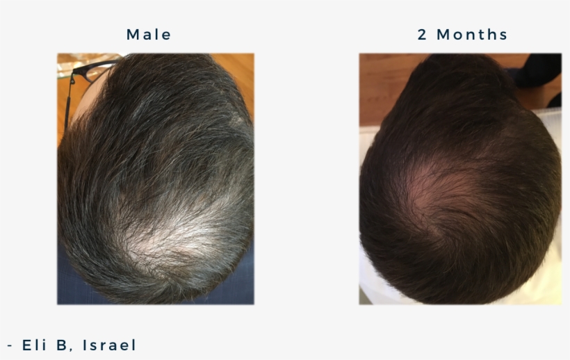 Male 20y, Androgenic Alopecia / Male Patterned Balding, transparent png #977333