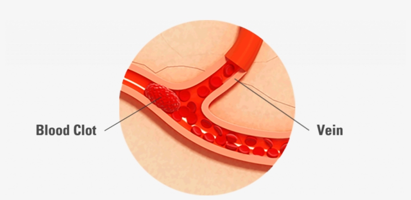 Blood Clots Are Thickened Clumps Of Blood That Can - Wood, transparent png #9713950