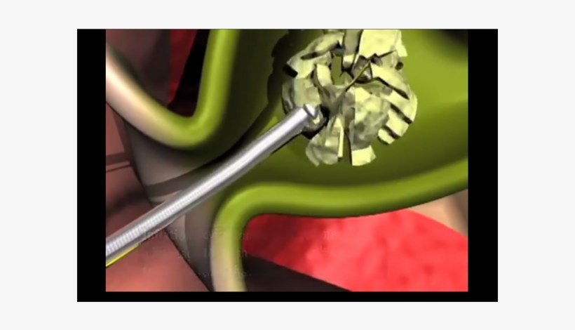 Flexible Yet Sturdy Catheter Is Designed To Bend With - Cable, transparent png #9753354