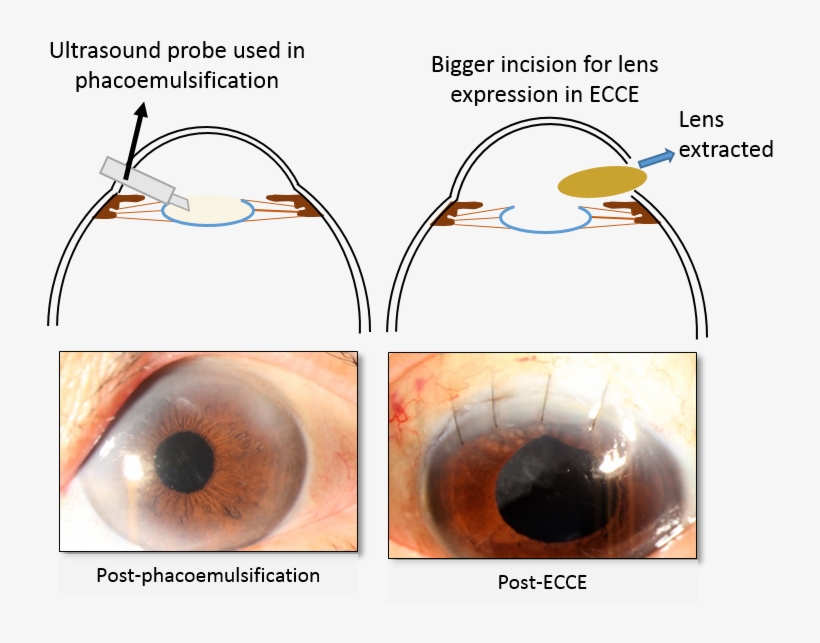 Cataract Surgery - Circle, transparent png #9768941