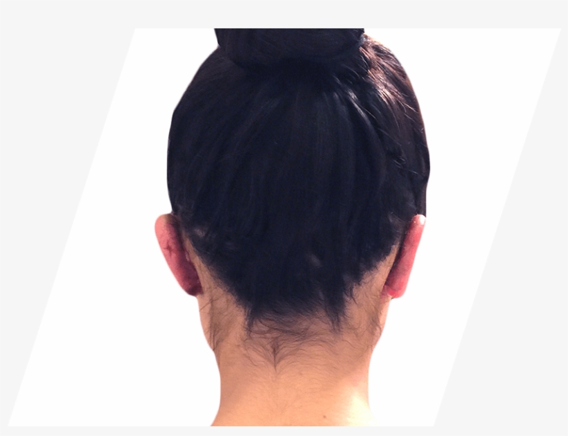 After Ear Surgery - Girl, transparent png #9769371