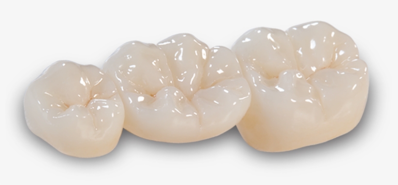 Bruxzir Anterior Crowns & Bridges - Crown, transparent png #982606