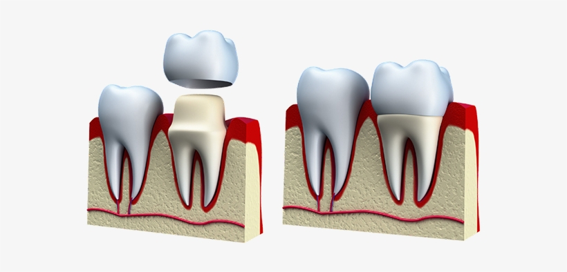 Crowns & Bridges - Crowns Bridges And Veneers, transparent png #982731