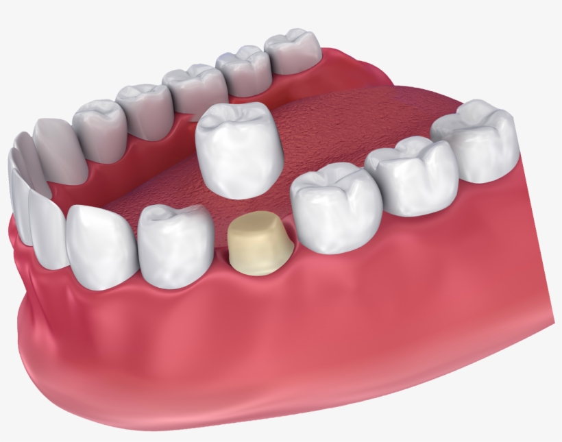 Digital Image Of A Dental Crown Being Placed - Dental Crown, transparent png #982734