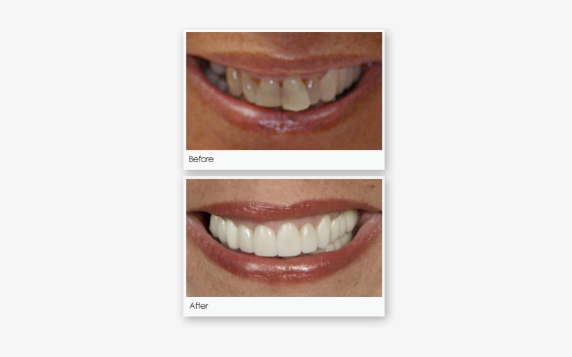 Crowns - Lieberman Larry T Dds Pa, transparent png #982954