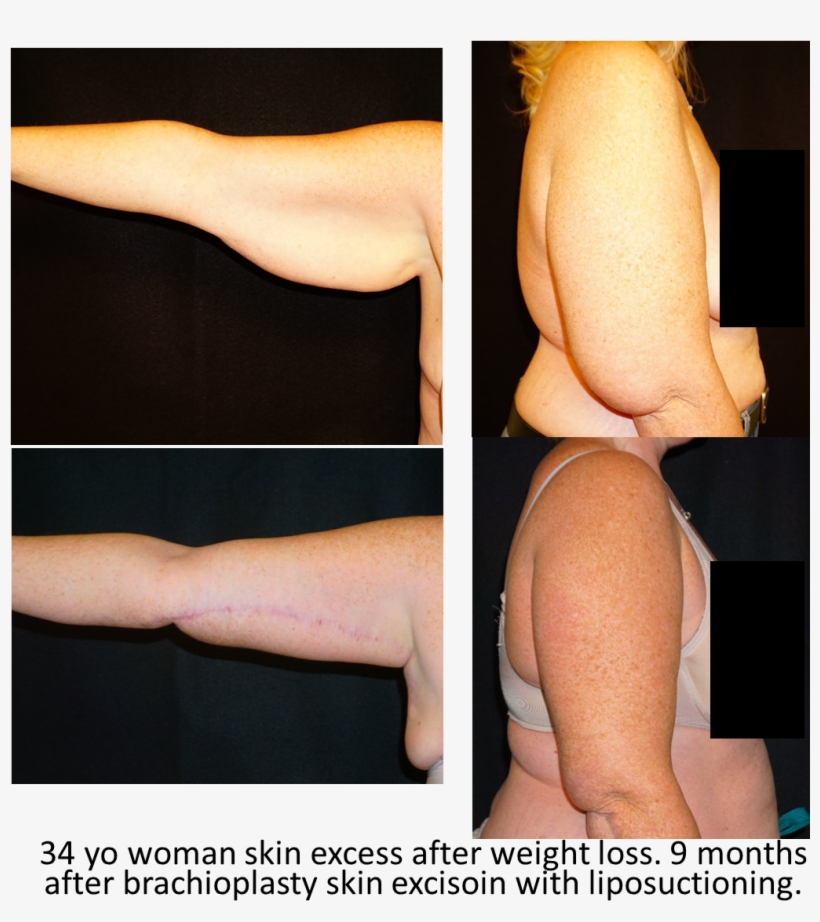 Arm Lift - Photo Caption, transparent png #9878432