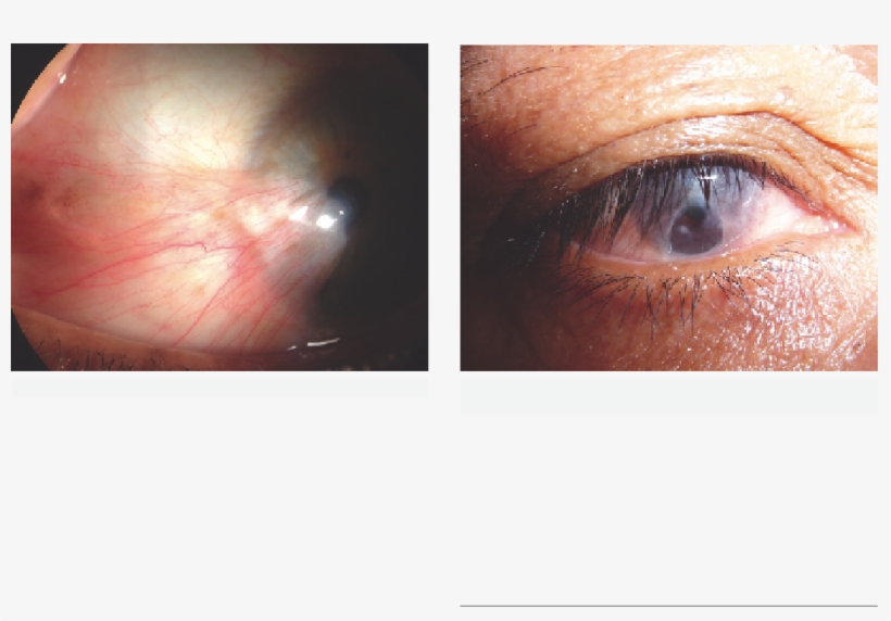 Ocular Surface Disease - Pterygium, transparent png #993978