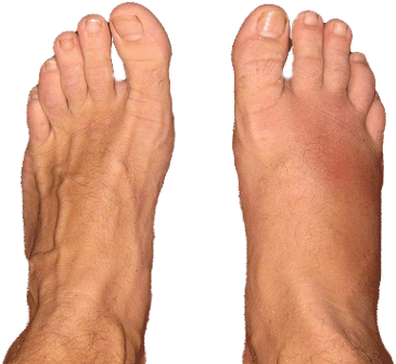 Edema Or Swollen Feet - Stress Fracture Foot (400x336), Png Download